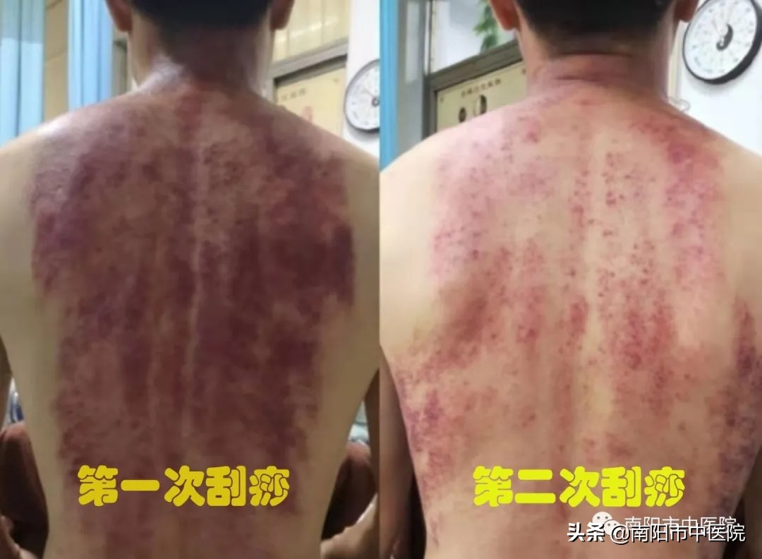 南阳市中医院开展多种中医特色治疗项目——虎符铜砭刮痧
