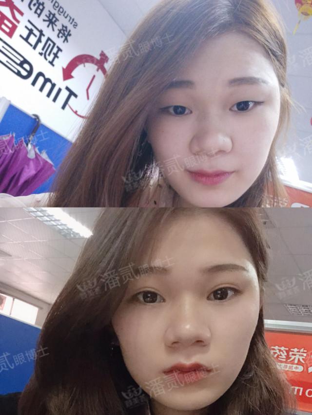 什么样的肿眼泡适合全切,什么样的肿眼泡不用动提肌