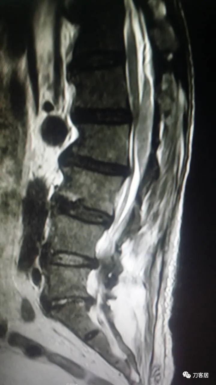 腰椎手术切掉棘突,腰突微创后出血肿