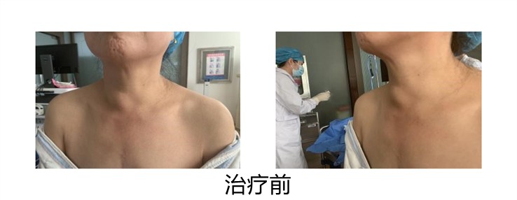 甲状腺消融术治疗甲状腺结节,甲状腺结节微创消融术器材