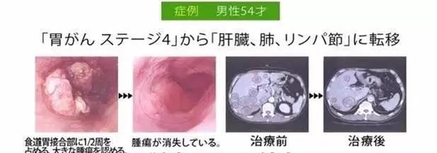 胃癌超过5年的真实案例,2021全球胃癌数据