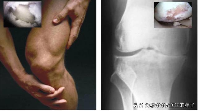 膝盖骨刺初期有什么症状,膝盖骨刺最严重后果怎样