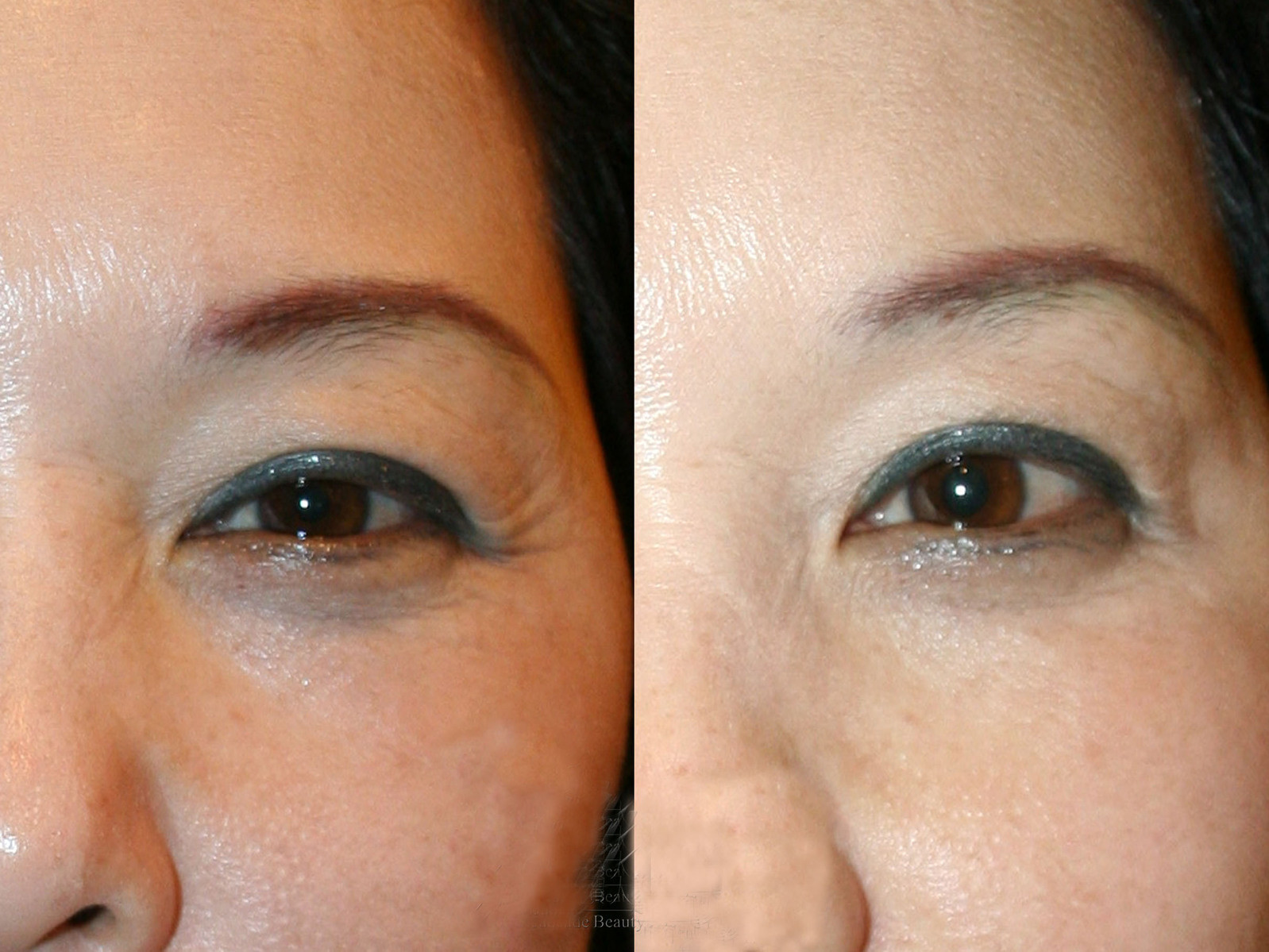 每个月花1000化妆品比不上医美吗？整形医生告诉你事实真相