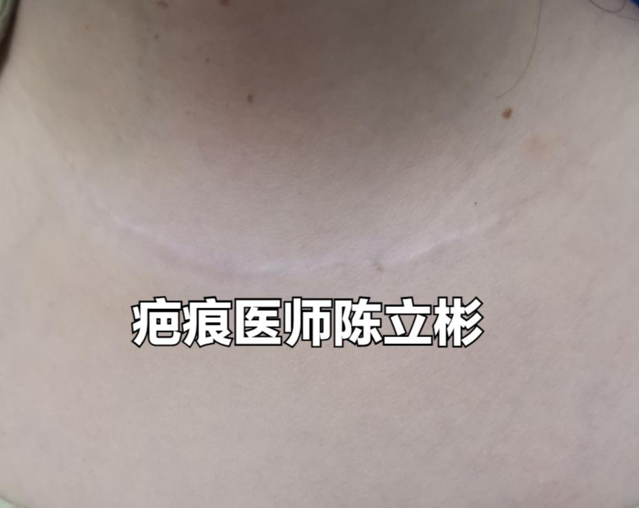 甲状腺结节手术后疤痕,祛甲状腺疤痕的小妙招