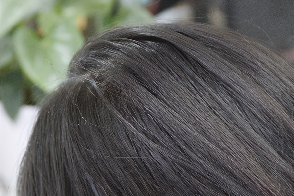 白头发越来越多是身体出了问题吗,长白发是缺乏哪些营养素