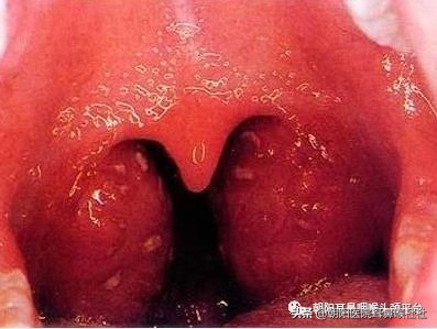 别拿扁桃体发炎不当回事