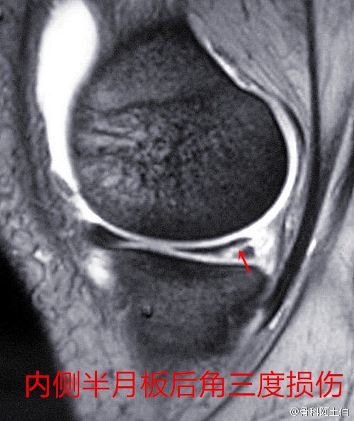 半月板撕裂是归骨科还是其它科,华西骨科半月板撕裂