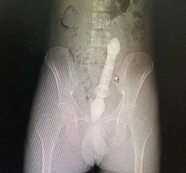 罗非鱼塞进直肠多长时间,罗非鱼直肠