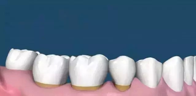 牙齿多久不刷会形成牙垢,牙齿背面没刷可以吗