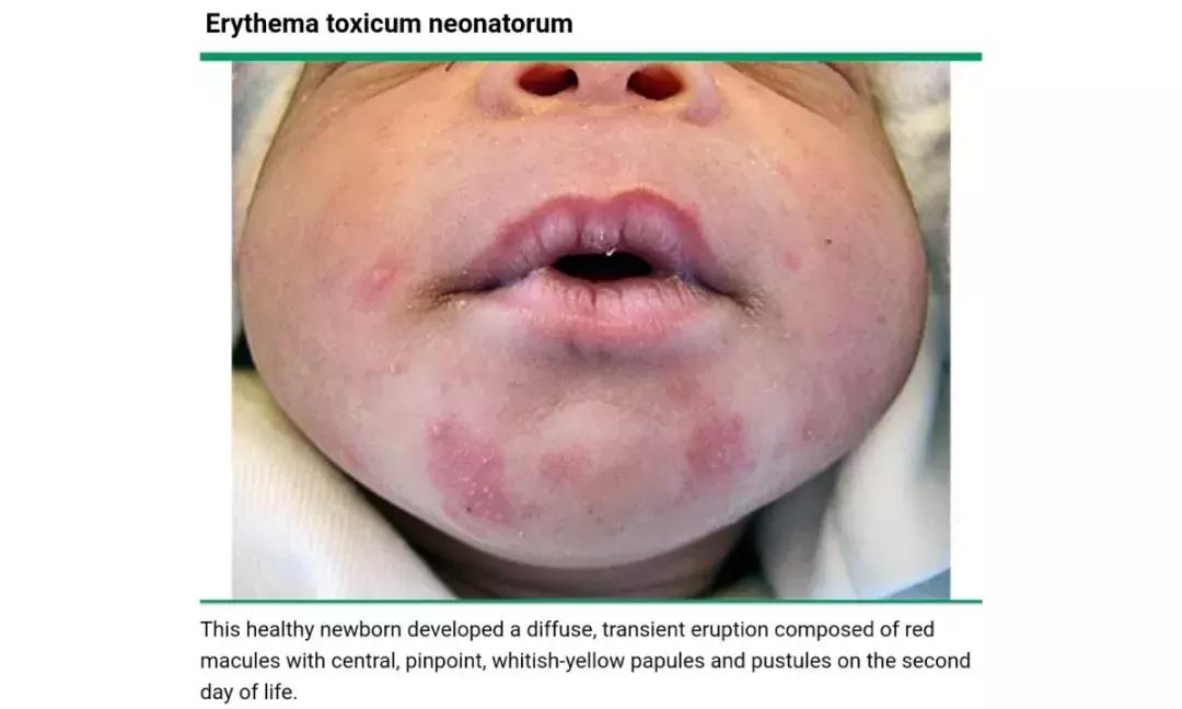 新生儿皮肤问题大全一览表,新生儿常见八大皮肤问题