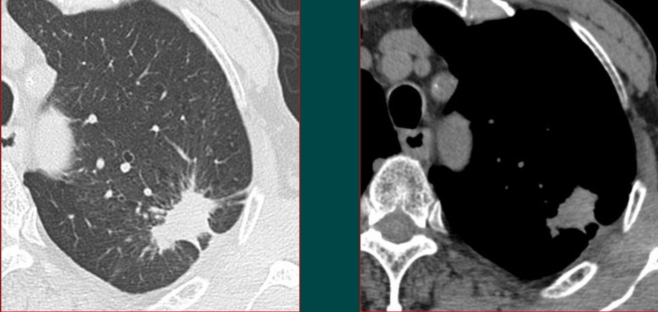 年年体检为啥查出癌症,每年正常体检能检查出肺癌吗
