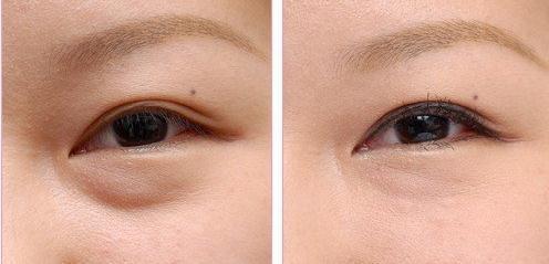 为什么睡那么早眼袋还是那么重,天天睡不好眼圈和黑眼袋特别重