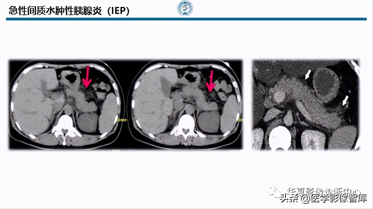 核磁ct都显示急性胰腺炎,急性坏死性胰腺炎的ct表现