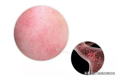 脸上角质层受损吃什么中成药,脸上的角质层受损怎样修复