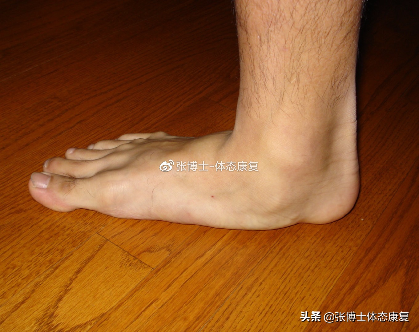 「体态矫正」怎样矫正鸭子步