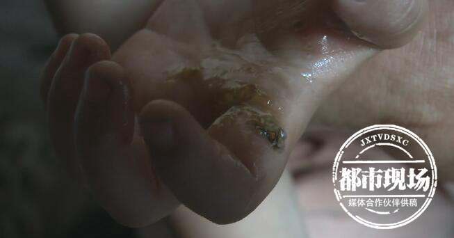 男童被裸露电线电击晕倒,十七岁男孩被电击烧伤