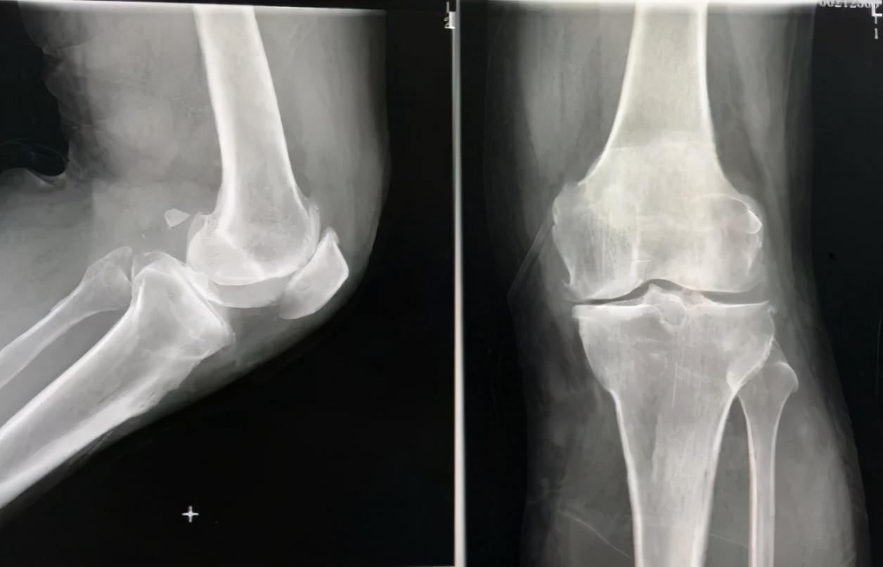 膝关节痛风肿胀疼痛怎么办,膝关节肿胀是痛风吗