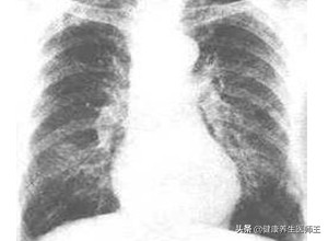 病毒性和细菌性呼吸道感染用药,细菌性上呼吸道感染的处方