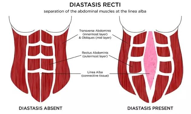 hiit燃脂肚子是怎样收紧的,产后肚皮松垮分享