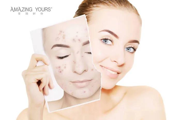 脸上长痘痘怎么排毒,脸上长痘痘应该做什么医美