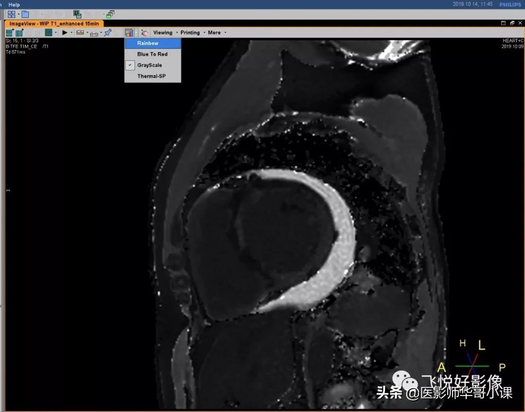 飞利浦磁共振快速扫描方案指南,飞利浦1.5t磁共振各部位扫描技术