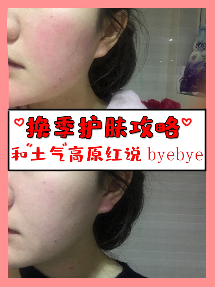 又到换季如何拯救你的敏感肌,敏感肌换季救星