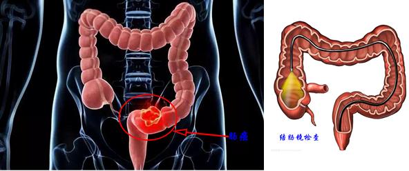 便血两个月发现直肠癌是早期吗,便血十多天查是肠癌肝癌