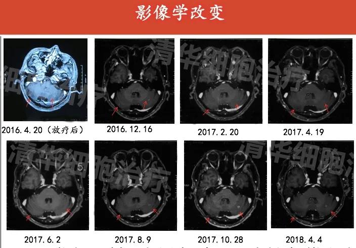 肺癌晚期活不了多久的症状,肺癌晚期生命只剩下六个月