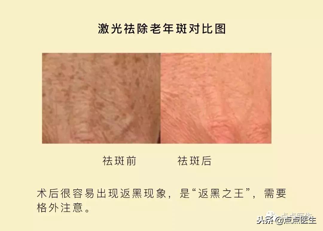 紧致抗衰用哪种激光好,抗衰用什么激光