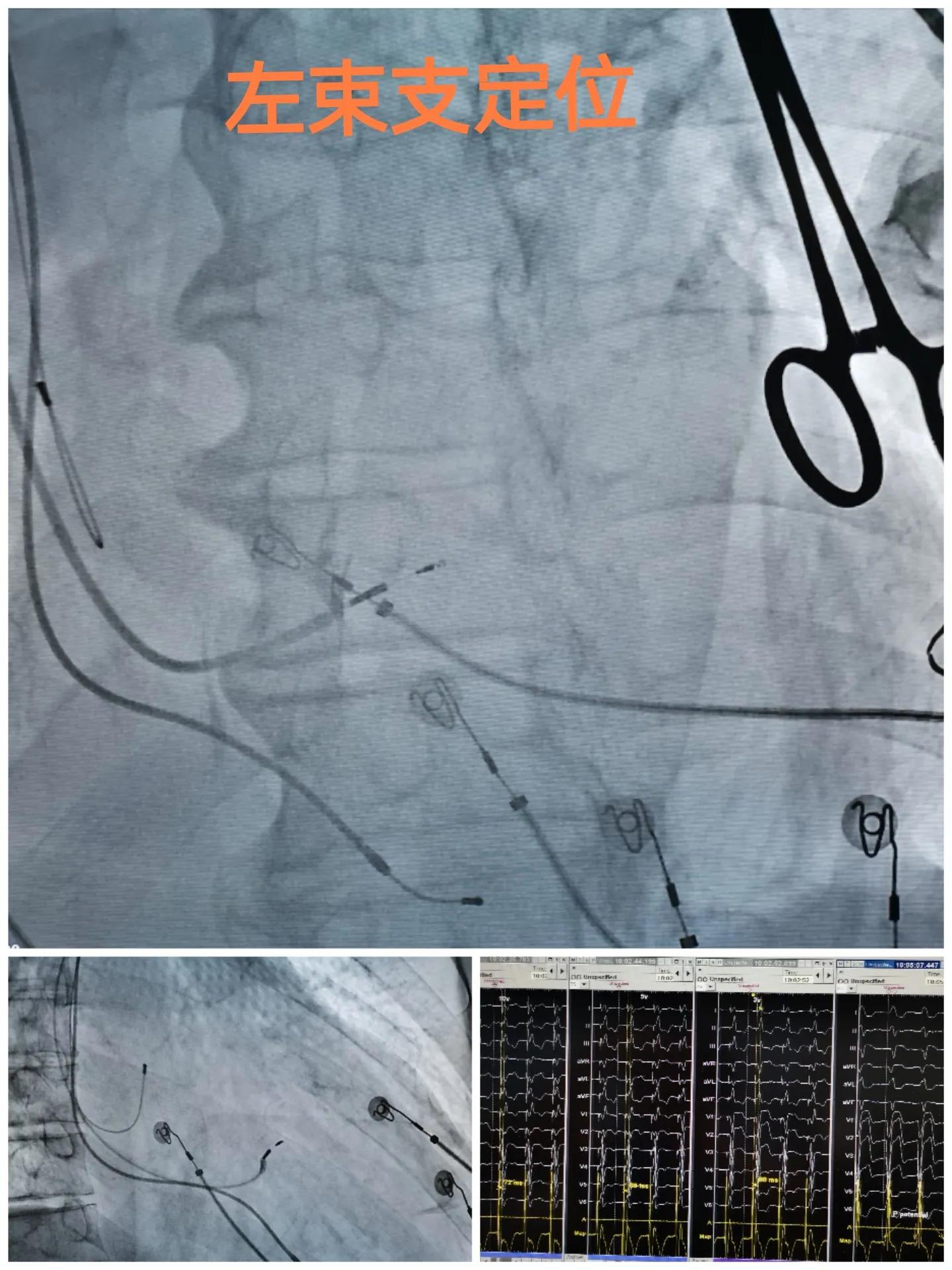 88岁老人心跳过快需要装起搏器吗,老人胸闷气短找中医看可以吗