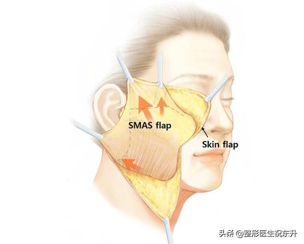 拉皮手术后的真实面部整形失败,脸部整形美容后遗症
