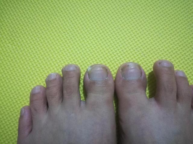 甲沟炎经验分享,甲沟炎的自愈经历