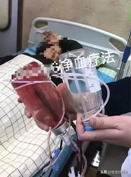 体外洗血,5万一次血液净化美容防癌