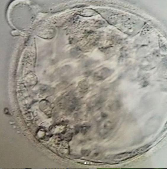 中医治疗卵泡发育不良视频,卵泡发育不良吃黑豆管用吗