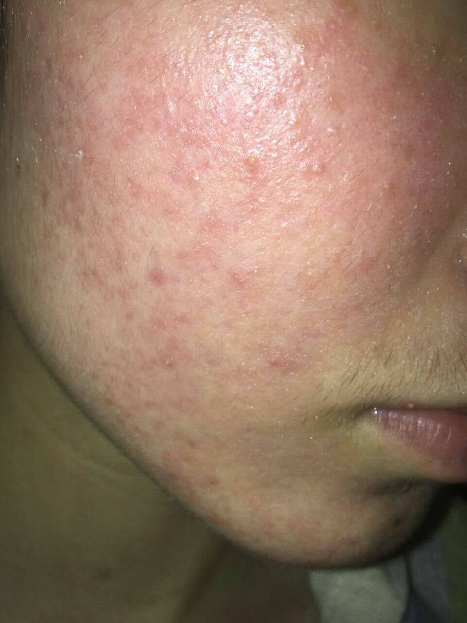 尼泊金酯钠防腐剂安全吗,尼泊金酯类防腐剂护肤品