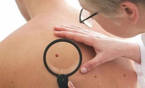 身上长痣怎么查是不是癌症,背上的痣长大了会变癌症吗
