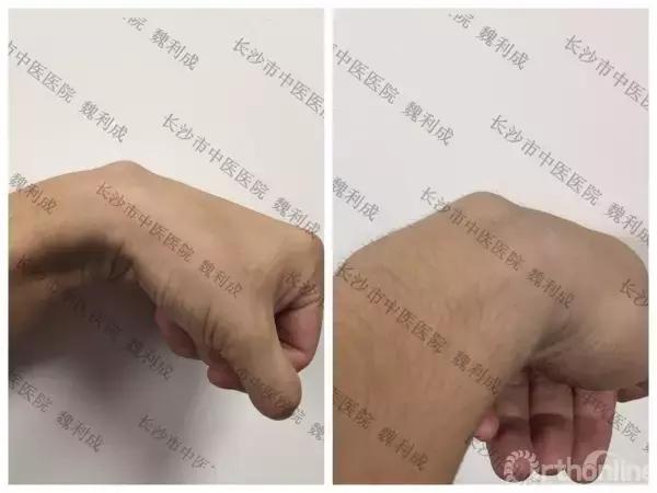 腱鞘囊肿除了手术还有什么办法,下颚有囊肿可以做穿刺手术