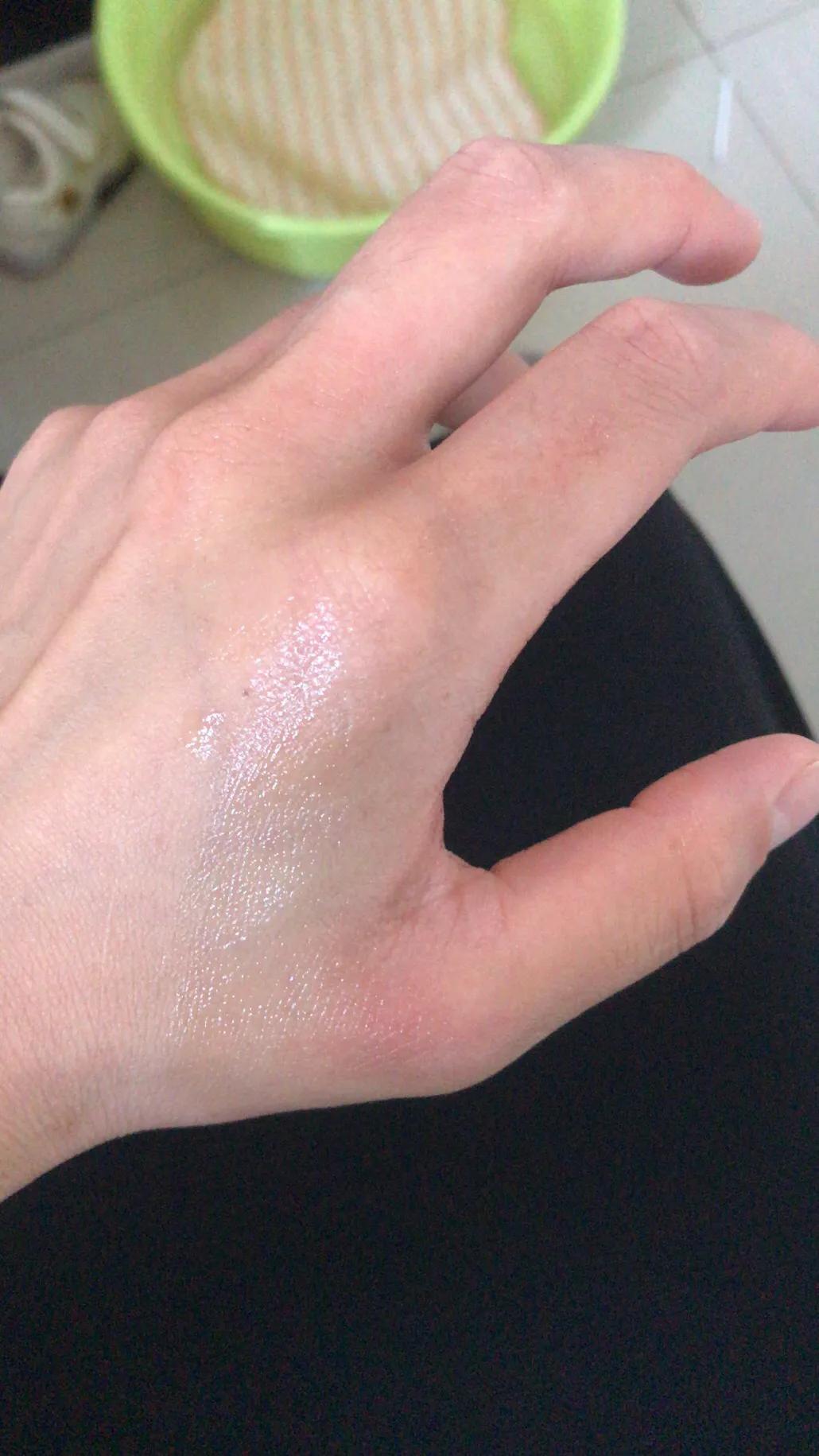 烫伤口红肿没起泡痛痒怎么回事,开水烫伤怎么处理不会留疤