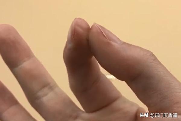 502把两个手指粘在一起了怎么分开,502胶水把两个手指粘一块了怎么办