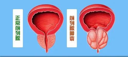 长期久坐的人怎样预防前列腺增生,如何预防前列腺炎和前列腺肥大