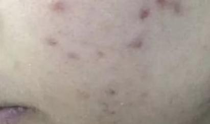 脸上痘印黑色素怎么消除,后背几年的痘印黑色素还能消除吗