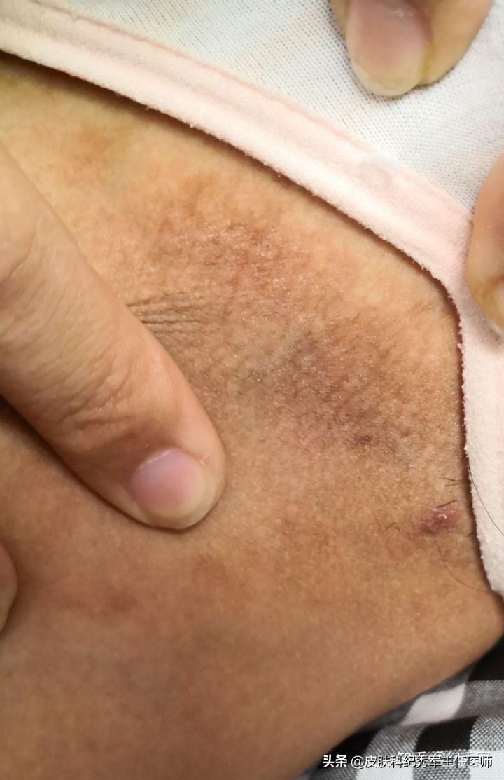 疥疮具有诊断意义,疥疮在临床上如何确诊