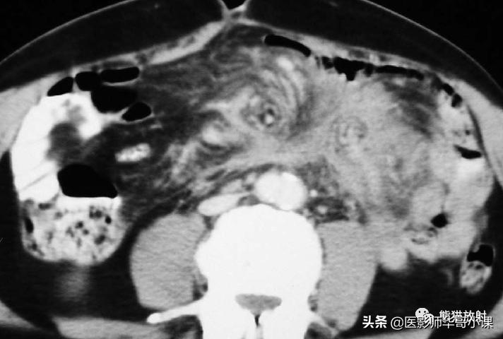 「精品课件」11种腹膜感染/炎症性病变的影像学表现