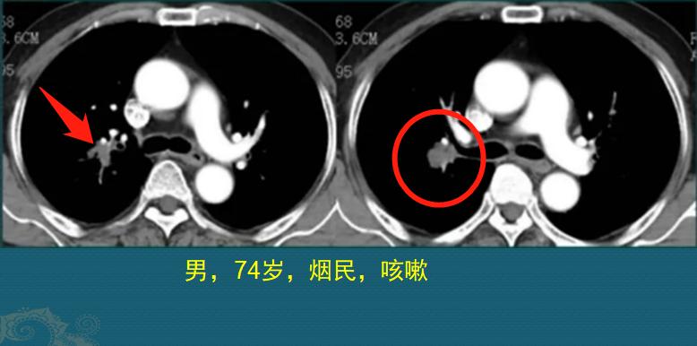怎样确定肺鳞癌生长速度过快,肺鳞癌肿瘤生长速度
