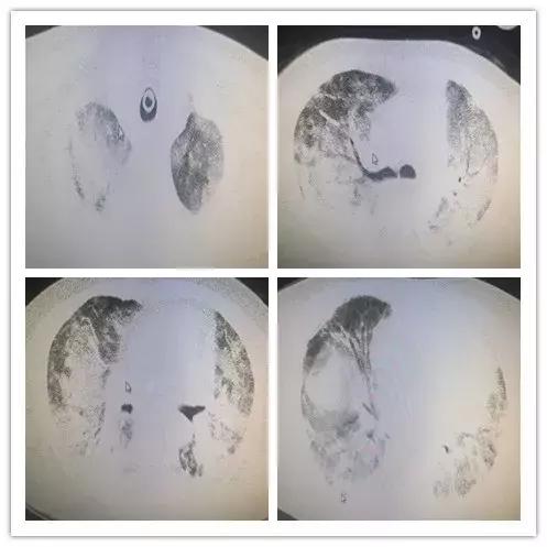 呼吸困难为主要症状的住院大病历,病人出现呼吸困难症状