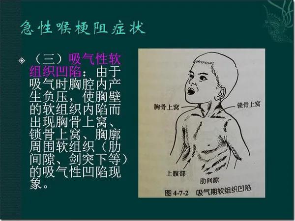孩子突然喉咙哑怎么回事,孩子突然嗓子哑了吃点什么药