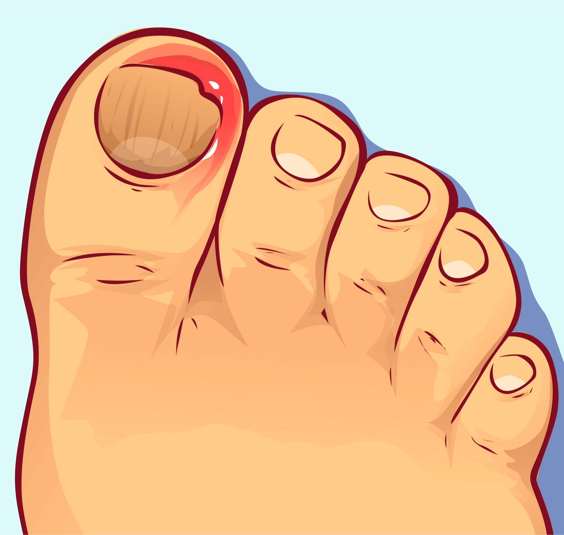 甲沟炎注意事项及禁忌,甲沟炎属于哪科疾病