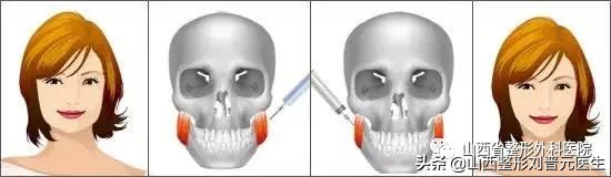肉毒素假的有效果么,肉毒素有什么要注意的