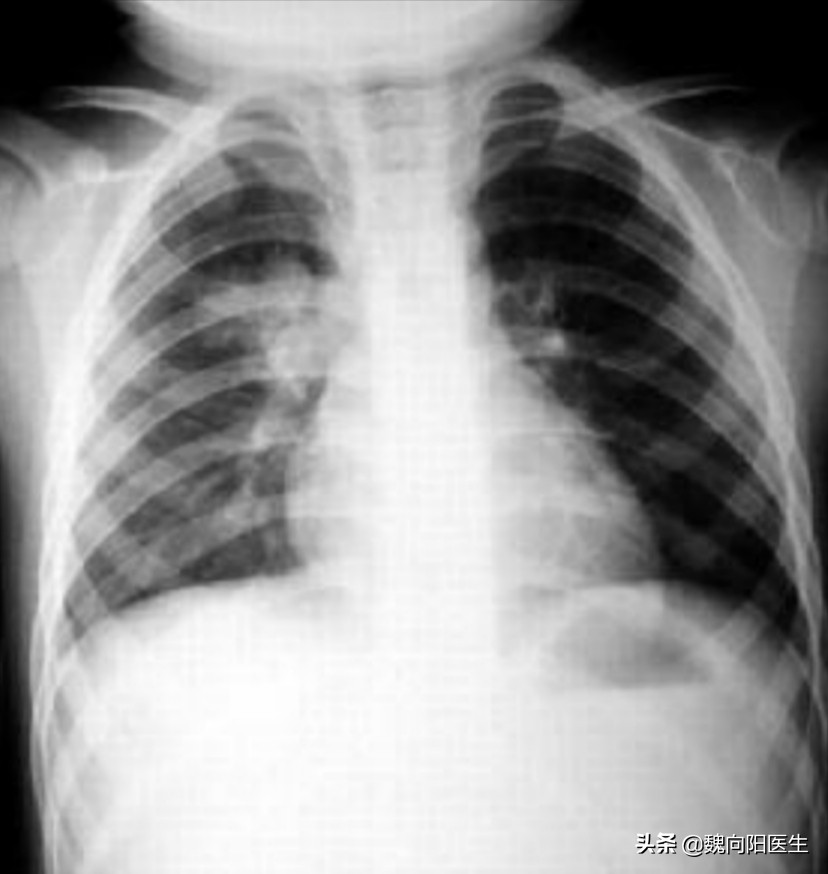 鍎跨鍖荤敓绉戞櫘鑲虹値濡備綍淇濆吇,瀹濆疂鑲虹値瀹堕暱濡備綍鎶ょ悊