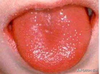 少儿川崎病,川崎病是什么样子的儿童